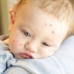 [Giải đáp]: Bị bọ chét cắn có nguy hiểm không? Thuốc điều bị bọ chét cắn
